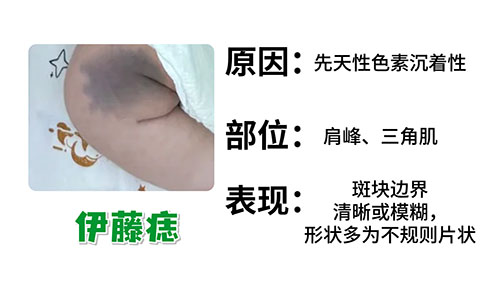 伊藤痣激光后需要防晒多久？南京胎记医生排名榜？