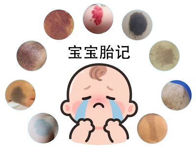 褐色胎记怎么回事？南京哪里有看褐色胎记的？