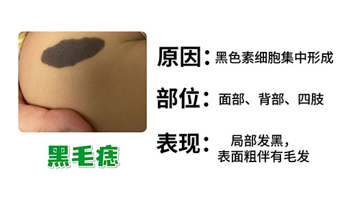 南京胎记专科医院：从小就有的黑色胎记会癌变吗？